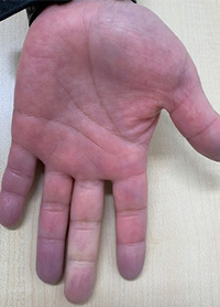 レイノー症状の手